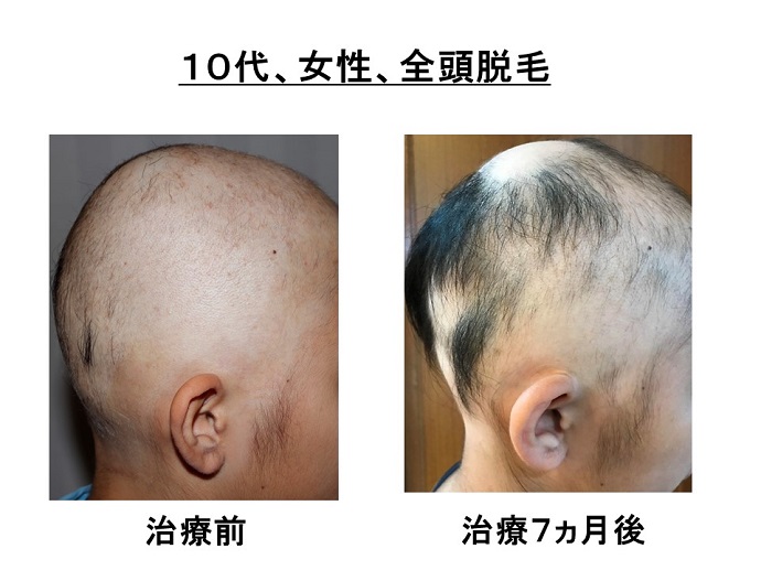 円形脱毛症　名医